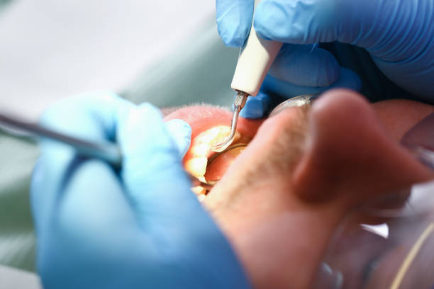 Best Emergency Tooth Extraction in Wildewood, MD