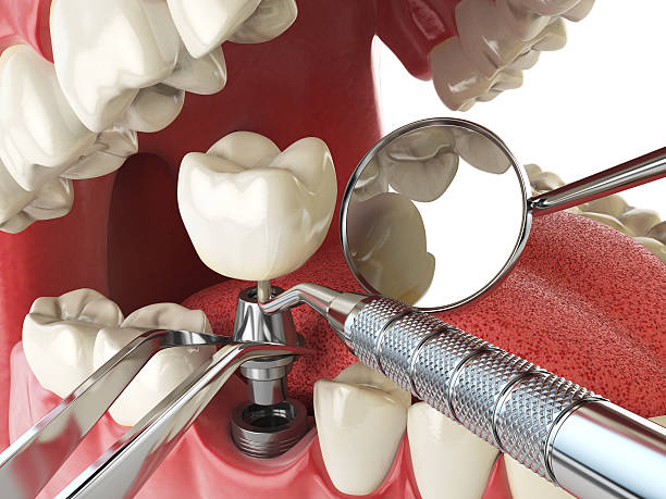 Best Emergency Tooth Extraction in Wildewood, MD